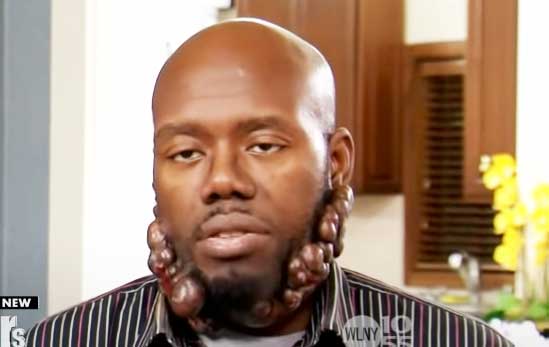 Man Desperate to Get Keloids Removed after 7 Failed Surgeries (video)